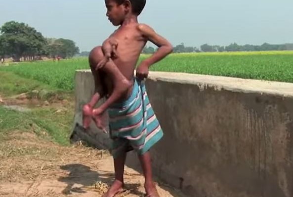 Ντίπακ: Το παιδί με τα 4 χέρια και 4 πόδια (βίντεο)