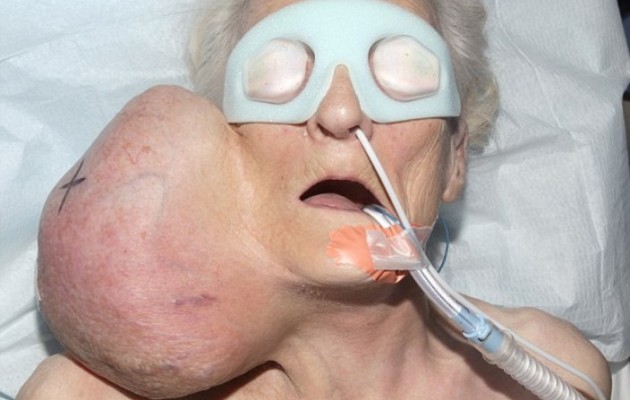 Της αφαίρεσαν από το λαιμό όγκο μεγέθους μπάλας ποδοσφαίρου