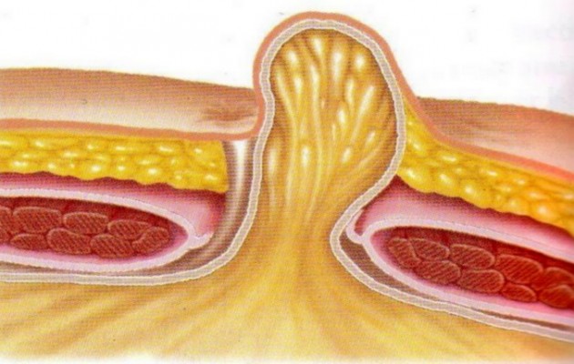 Τι πρέπει να ξέρετε για την επιγαστρική κήλη