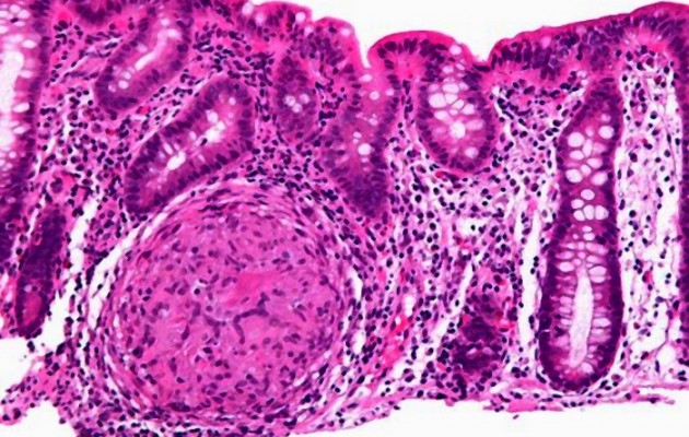 Η σωστή διατροφή  προφυλάσσει από τα εκκολπώματα του παχέος εντέρου