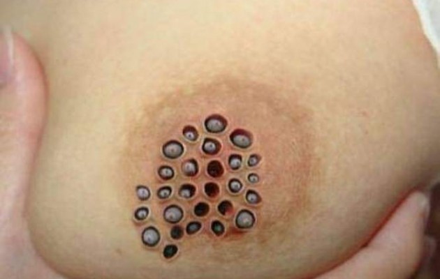 Μάθετε την αλήθεια για τη “φοβερή ασθένεια που τρώει το στήθος”