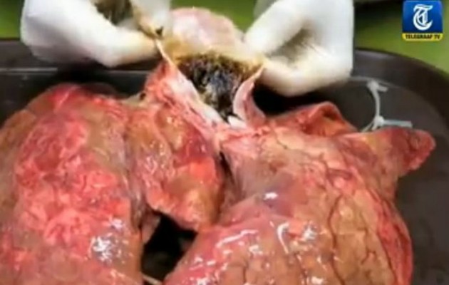 ΣΟΚ: Δείτε τα πνευμόνια σας μετά από 60 τσιγάρα (βίντεο)