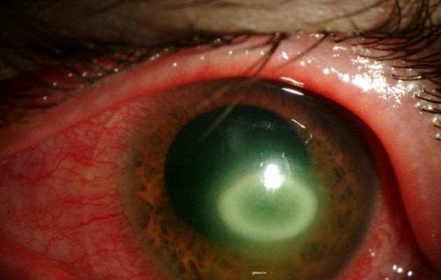 Προσοχή: Ένα μικρόβιο της “έφαγε” τα μάτια επειδή φορούσε 6 μήνες τους ίδιους φακούς επαφής