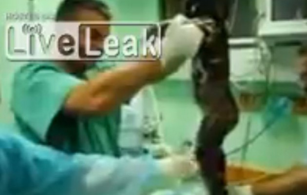 Γάζα – ΣΟΚ: Βρέφος καμένο από τους βομβαρδισμούς παλεύει για την ζωή του (βίντεο)