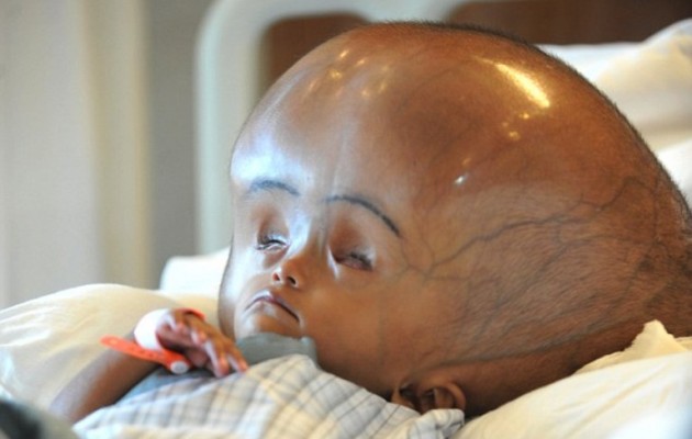 Κορίτσι με ακραία υδροκεφαλία κατάφερε να επιβιώσει και να χαμογελάσει!