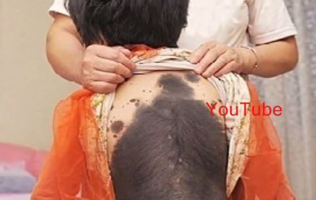 Κίνα: Το δράμα της 6χρονης που βγάζει τρίχες παντού (βίντεο)