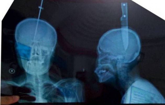 Απίστευτες εικόνες: Της καρφώθηκε στο κεφάλι ένα μαχαίρι 11 εκατοστών και επέζησε