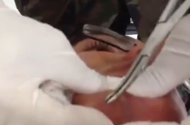 Δεν θα πιστεύετε τι έβγαλαν από το πρόσωπό του (βίντεο)