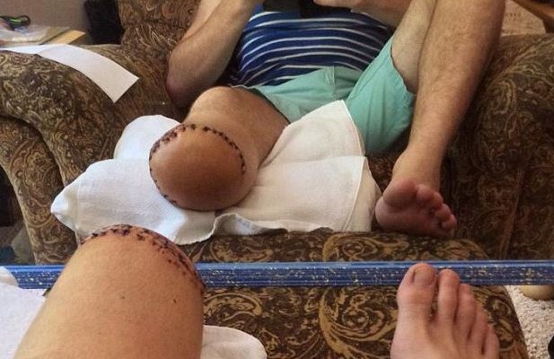 ΗΠΑ: Έκοψε το πόδι του για να συνεχίσει να κάνει… extreme sports (φωτογραφίες)