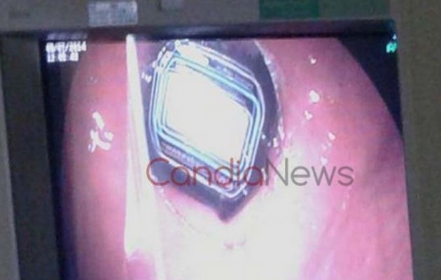 Ηράκλειο: Αφαίρεσαν ρολόι από το… στομάχι του (φωτογραφίες)