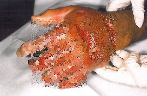 ΣΟΚ: Λουόμενοι κινδυνεύουν από βακτήριο που τρώει την σάρκα