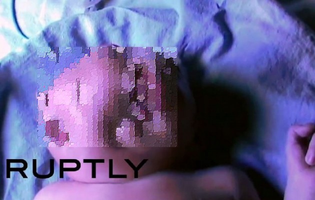 Μάχη για την ζωή δίνει βρέφος που γεννήθηκε με δύο πρόσωπα (βίντεο)