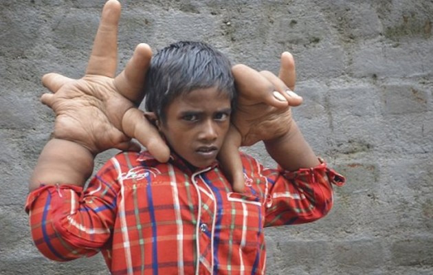 Ινδία: Σοκάρει ο 8χρονος με τα χέρια που ζυγίζουν 12,5 κιλά (εικόνες)