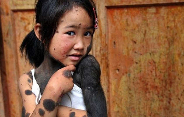 Η τραγική ιστορία της 6χρονης Λίου που πάσχει από σπάνια ασθένεια