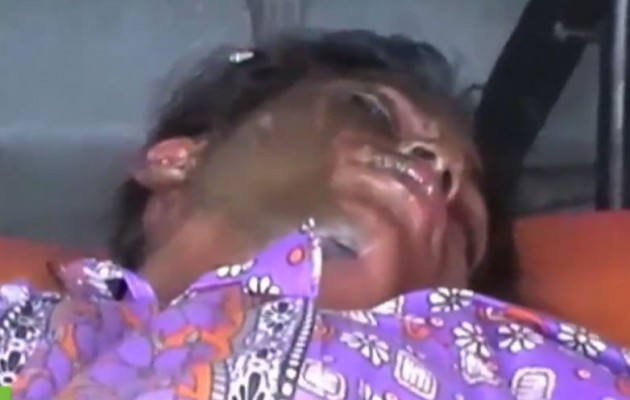 Φοιτήτρια σε κρίσιμη κατάσταση μετά από επίθεση με οξύ (βίντεο)