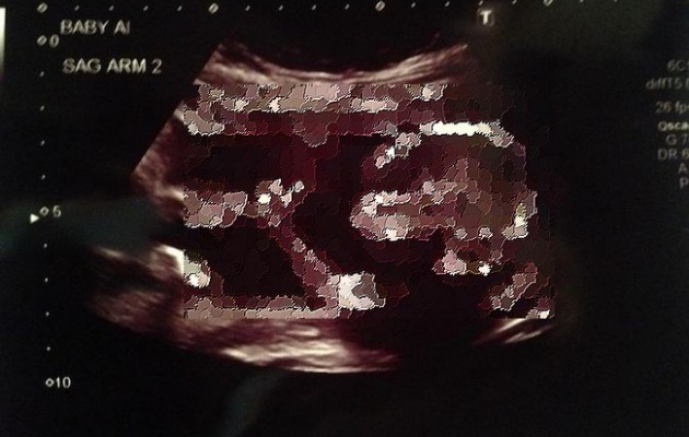 Δείτε το έμβρυο που έγινε viral από το… υπερηχογράφημα (φωτογραφία)