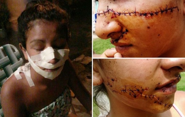 Σημάδεψαν 15χρονη γιατί ήταν πολύ όμορφη! (φωτογραφίες)