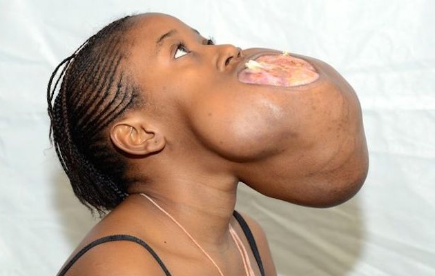 Όγκος μεγέθους μπάλας μπάσκετ αφαιρέθηκε από κορίτσι (βίντεο + φωτο)