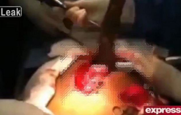 Έβγαλαν από την κοιλιά του ψάρι 60 εκατοστών (βίντεο)