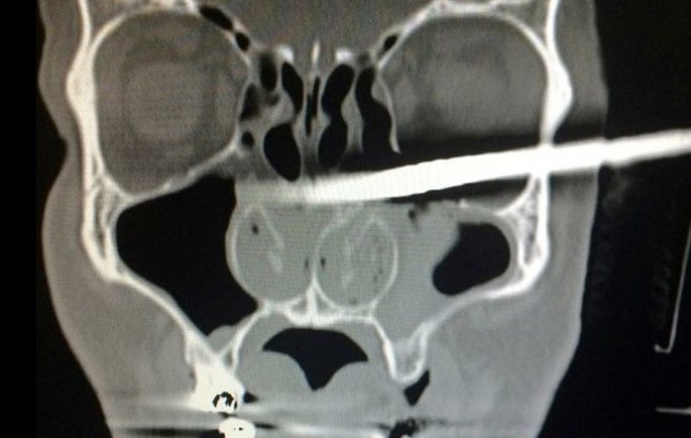 Πήγε στο νοσοκομείο με ένα ξύλο καρφωμένο στο κεφάλι του (φωτογραφία)