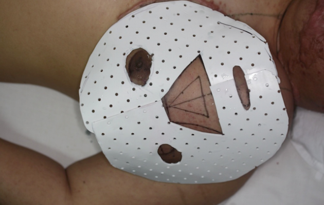 Άνδρας “μεγαλώνει” το νέο του πρόσωπο στο στήθος του (φωτό)