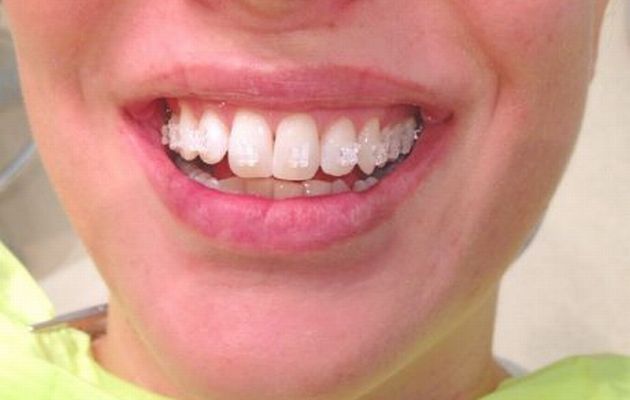 Ελληνίδα παρουσιάστρια έβαλε σιδεράκια