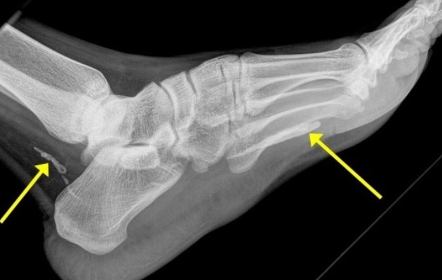 Σκουλήκι ενός μέτρου ζούσε στην πατούσα άνδρα