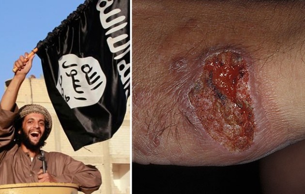 Ισλαμικό Κράτος: Σαρκοφάγα νόσος “τρώει” τα κορμιά των τζιχαντιστών στη Συρία