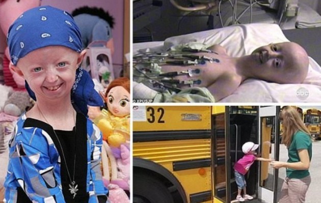 Πέθανε η 17χρονη με το σώμα 100χρονης γυναίκας