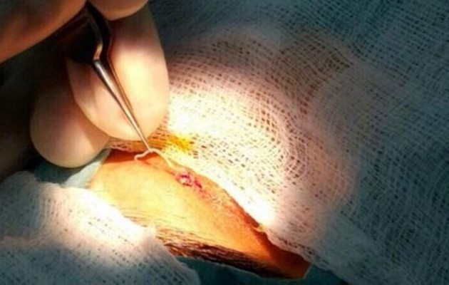 Γιατροί στο Ντουμπάι έβγαλαν σκουλήκι 12 εκ. από το μάτι γυναίκας