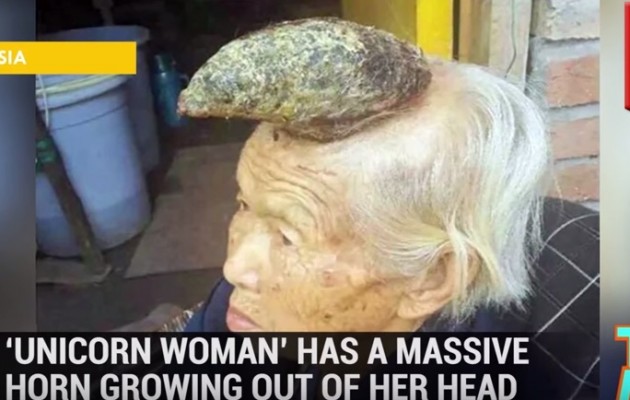 Κινέζα έβγαλε κέρατο 12 εκατοστών πάνω στο κεφάλι της (βίντεο)