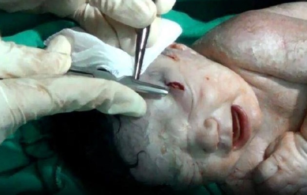 Κοριτσάκι γεννήθηκε με θραύσμα από οβίδα στο κεφάλι (φωτο + βίντεο)