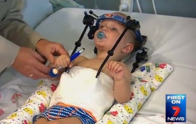Γιατροί επανένωσαν το κεφάλι με το σώμα ενός αγοριού 16 μηνών! (φωτο)