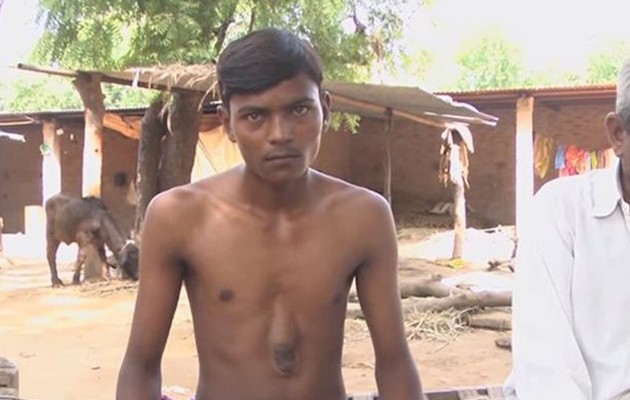 Σπάνιο ιατρικό φαινόμενο – Ινδός ζει με εξωτερική καρδιά (βίντεο)