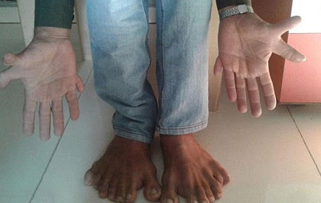 Aπίστευτο: Ινδός έχει συνολικά 28 δάχτυλα! (φωτο)