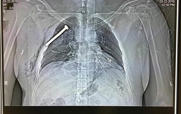 Βρυξέλλες: Γεμάτη καρφιά η βόμβα που έσπειρε τον θάνατο στο αεροδρόμιο