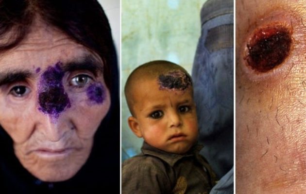 Σαρκοφάγα νόσος “το ΄σκασε” από το Ισλαμικό Κράτος και εξαπλώνεται μέσω προσφύγων