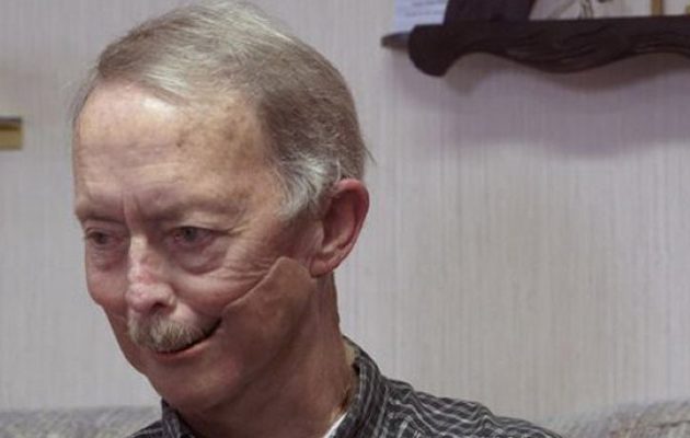 Καρκινοπαθής απέκτησε σαγόνι από 3D εκτυπωτή