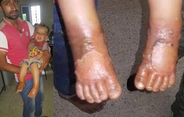 Φρίκη! Οι τζιχαντιστές του Ερντογάν βομβάρδισαν γυναικόπαιδα με χημικά (φωτο)