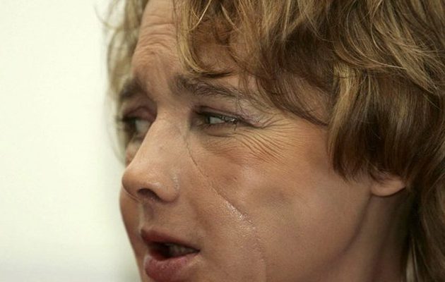 Πέθανε η γυναίκα που υποβλήθηκε στην πρώτη μεταμόσχευση προσώπου παγκοσμίως
