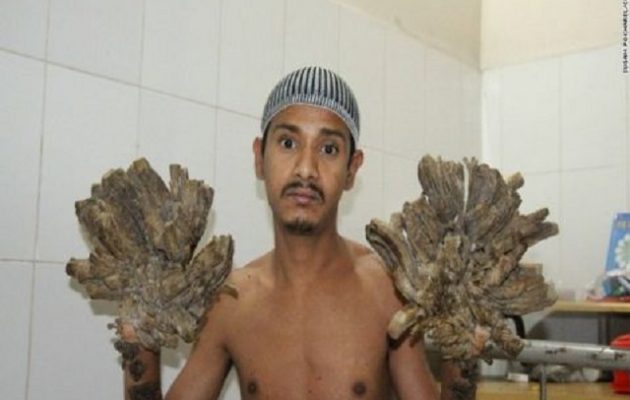 Μπαγκλαντές: Χειρουργήθηκε ο άνθρωπος-δένδρο – Δείτε πώς έγινε (φωτο)