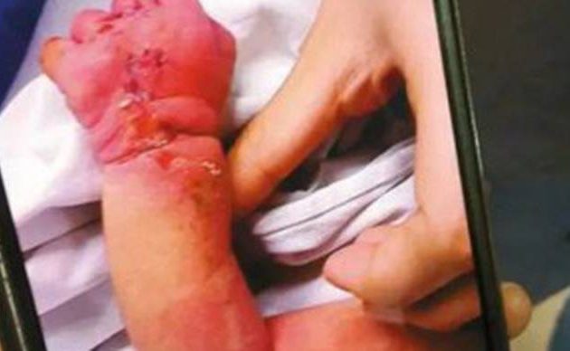 Σοκ στην Πάτρα: Νεαροί γονείς έκαιγαν με τσιγάρα και κτυπούσαν το 7 μηνών παιδί τους