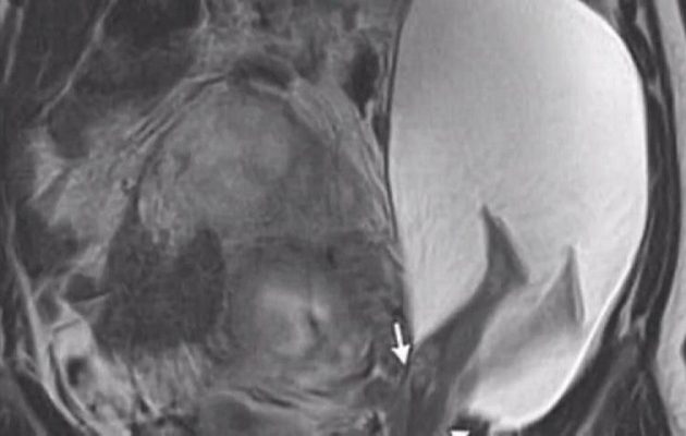 Απίστευτο: Έγκυος έπαθε ρήξη μήτρας από… κλωτσιά του εμβρύου (βίντεο)