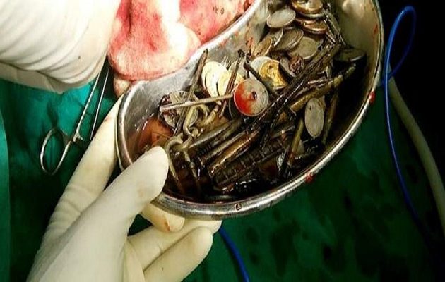 Iνδός είχε καταπιεί κέρματα καρφιά, πέτρες και δεκάδες ξυραφάκια! (βίντεο)