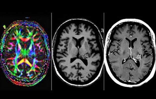 Γυναίκα που «της μίλαγε ο Θεός» αποδείχτηκε ότι είχε όγκο στον εγκέφαλο