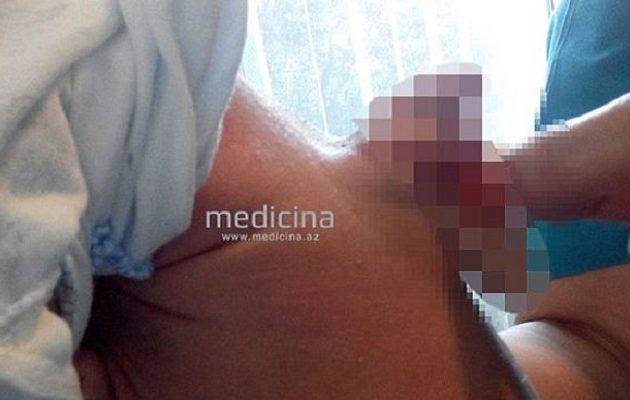 Απίστευτο: Αγοράκι γεννήθηκε με ένα δεύτερο πέος στην πλάτη