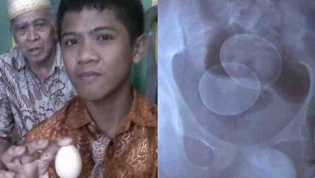 Μοναδικό φαινόμενο: 14χρονος γεννά αυγά στην Ινδονησία