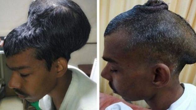 31χρονος Ινδός είχε όγκο δύο κιλών στο κεφάλι του