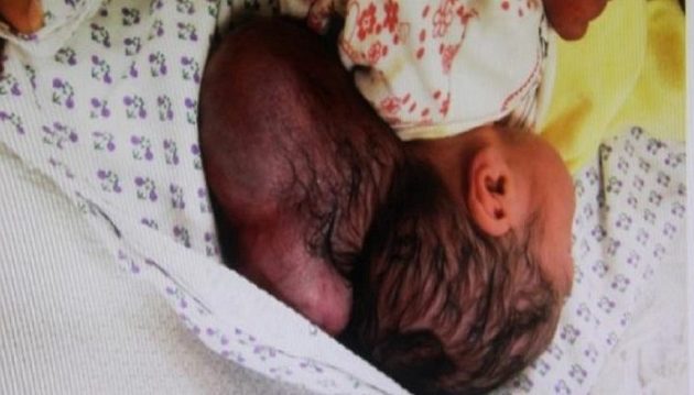 Αγόρι γεννήθηκε με «δύο» κεφάλια στην Τουρκία