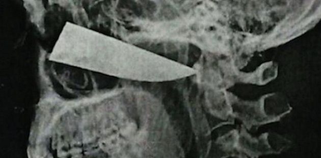 25χρονος έζησε με ένα μαχαίρι καρφωμένο στο κεφάλι για τέσσερις μέρες
